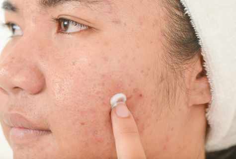 How to get rid of scars from pimples